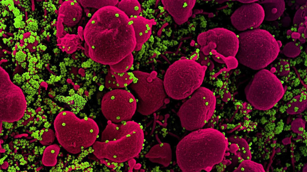 Micrografía electrónica de barrido coloreada de una célula apoptótica (rosa) muy infectada con partículas del virus SARS-COV-2 (verde), aislada de una muestra de un paciente