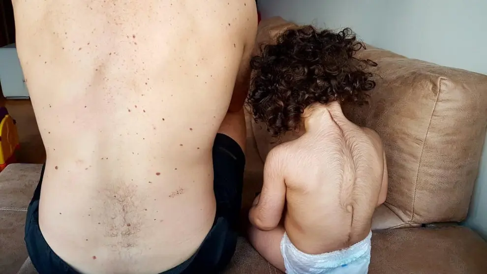 Ni&ntilde;a de Cantabria afectada por hipertricosis