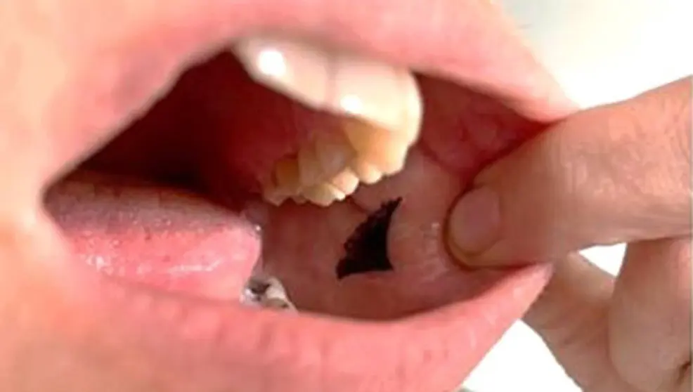 Un prototipo de parche se adhiere c&oacute;modamente al interior de la mejilla para administrar la insulina. ACS APPLIED BIO MATERIALS 04:2:2022