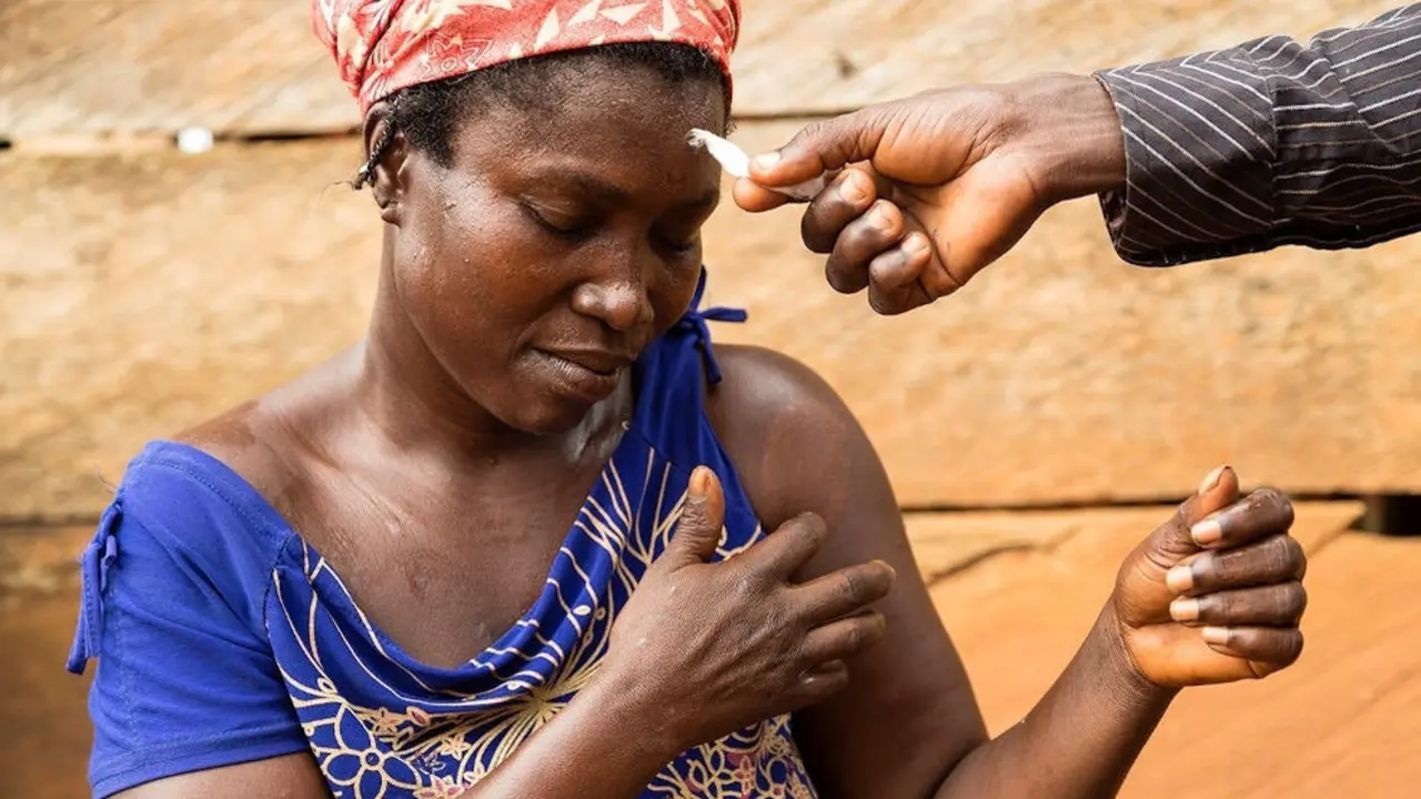 Una mujer con lepra | Foto- Archivo
