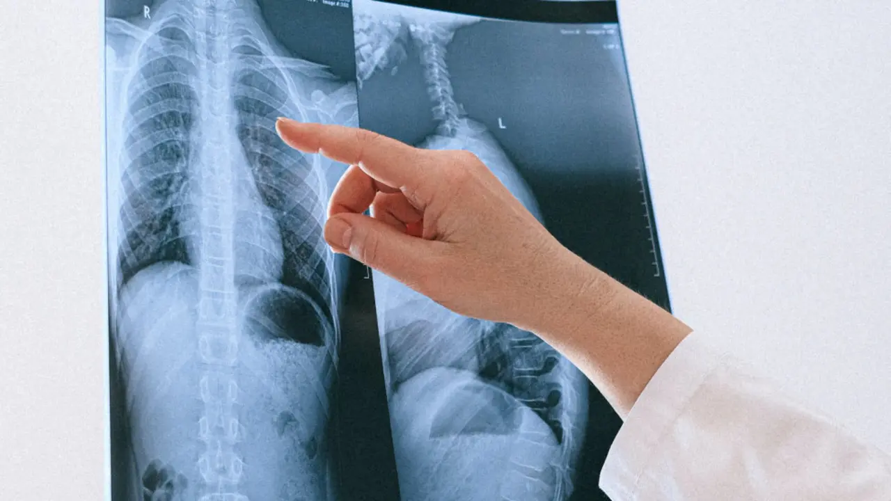 Radiograf&iacute;a de pulm&oacute;n